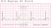Third Degree AV Block – ECG Result