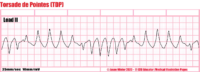 Torsade De Pointes (TDP) – Cardiac Nursing Notes – ECG