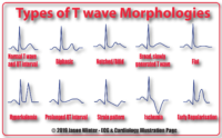 Types Of T Wave Morphologies – Cardiac Nursing Notes