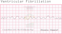 Ventricular Fibrilattion – ECG Result