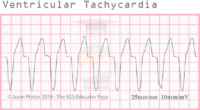 Ventricular Tachycardia – ECG Result