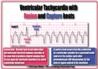 Ventricular Tachycardia With Fusion And Capture Beats