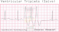 Ventricular Triplets (Salvo) – ECG Result