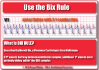 What İs The Bix Rule – Cardiac Nursing Notes