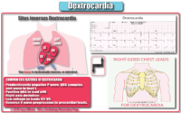 What İs The Dextrocardia – Cardiac Nursing Notes