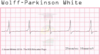 Wolff – Parkinson White – ECG Result