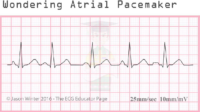 Wondering Atrial Pacemaker – ECG Result