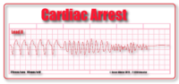 what does cardiac arrest ecg look like